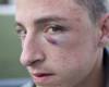 Un juvenil, hospitalizado tras ser golpeado con un casco de moto